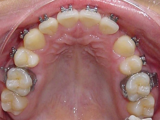 2. Zahnlücke nach Zahnentfernung schon kleiner geworden