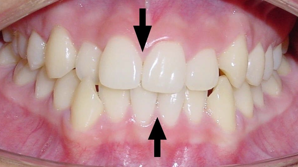 Vor der Behandlung: Mittellinienverschiebung bei den Zähnen von Ober- und Unterkiefer, MLV