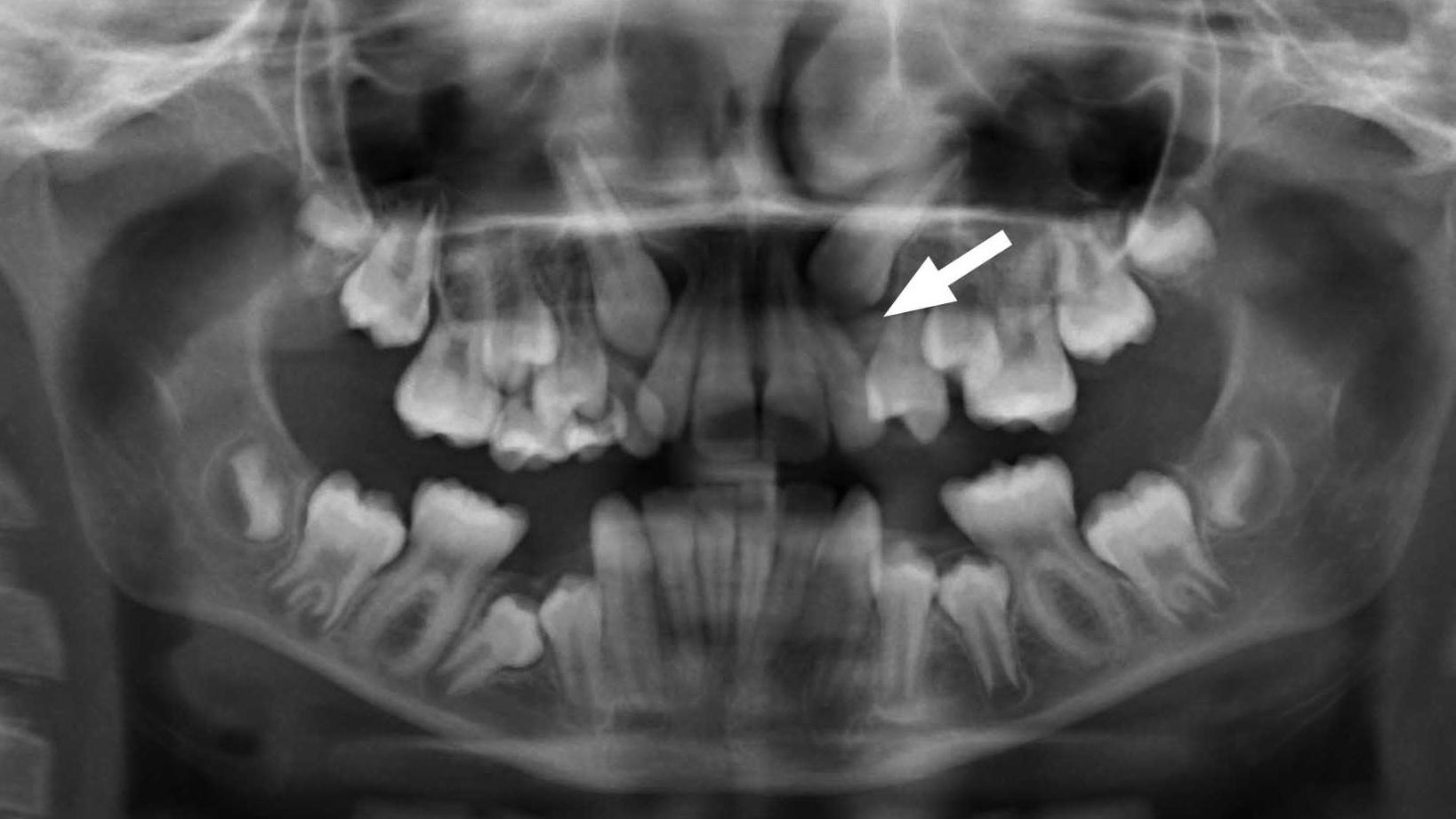Röntgenbild von Zähnen mit Platzmangel