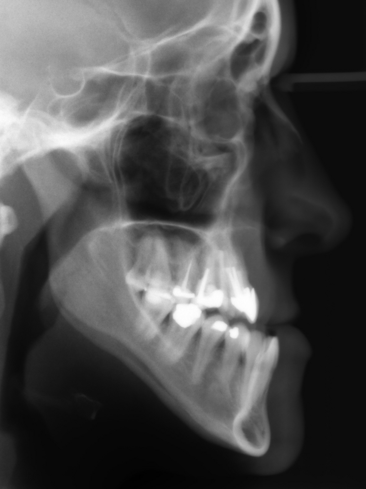 Röntgenbild der Patientin mit vorstehendem Unterkiefer