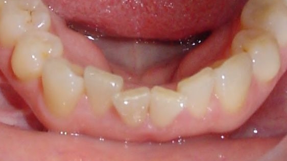 Engstand der Zähne im Unterkiefer