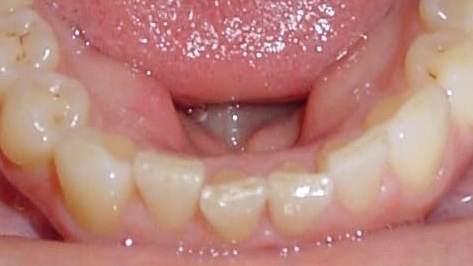 Beginnende Ausformung des Zahnbogens mit Schienen von Invisalign