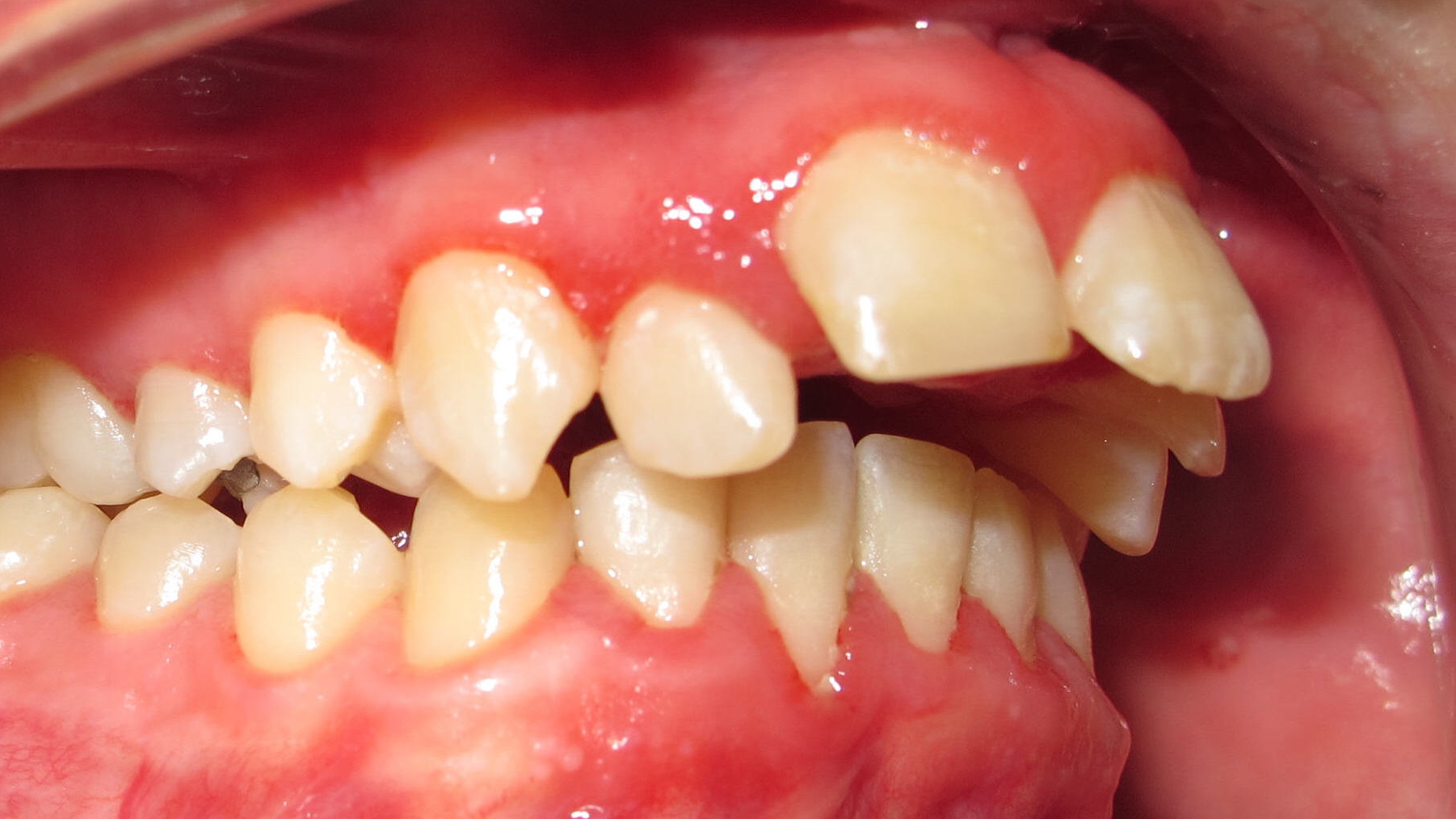 Vorstehende Zähne durch Daumenlutschen