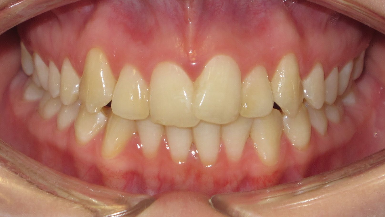 Annas Zähne vor der Invisalign-Behandlung