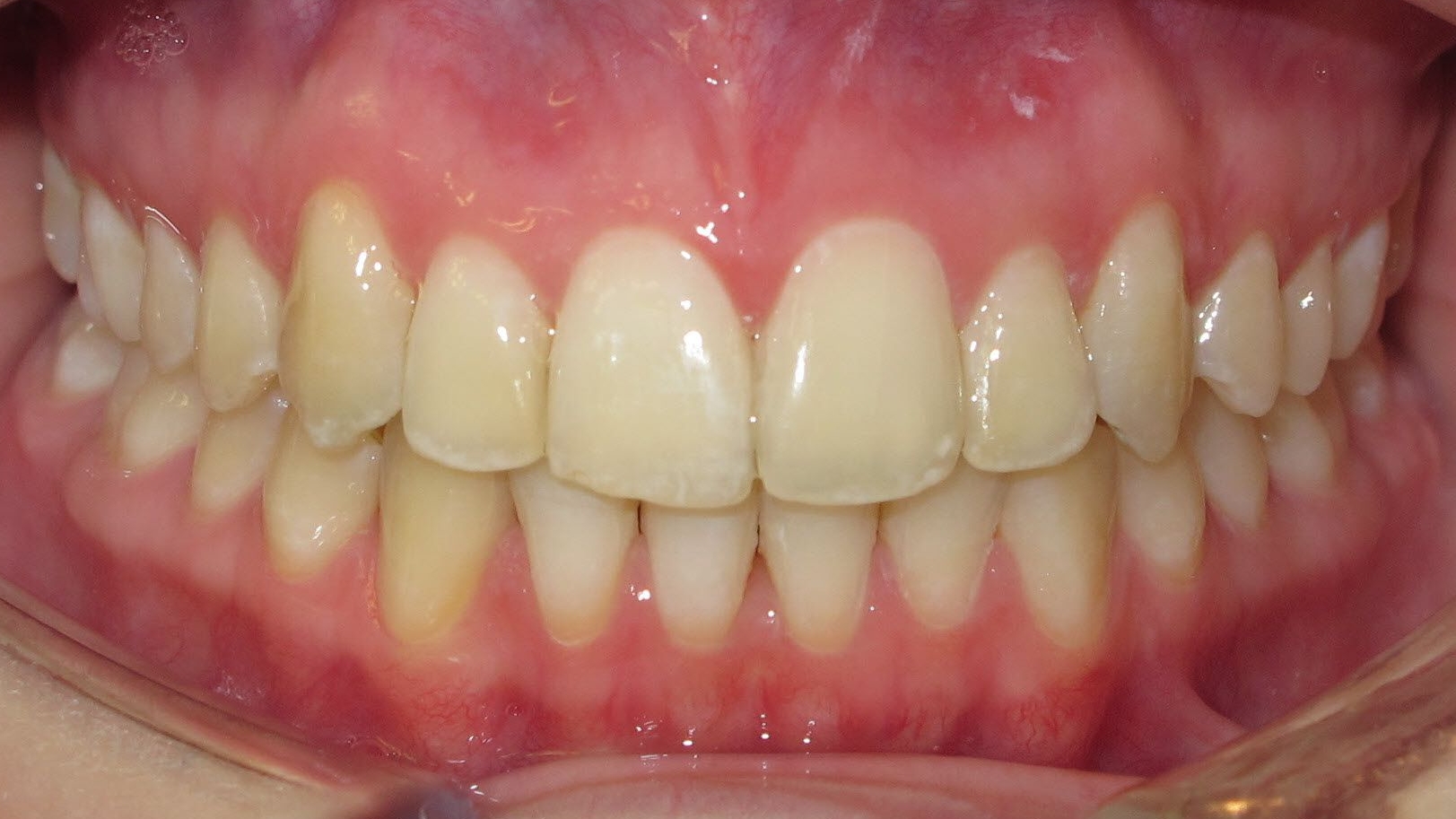 Annas Zähne nach der Invisalign-Behandlung